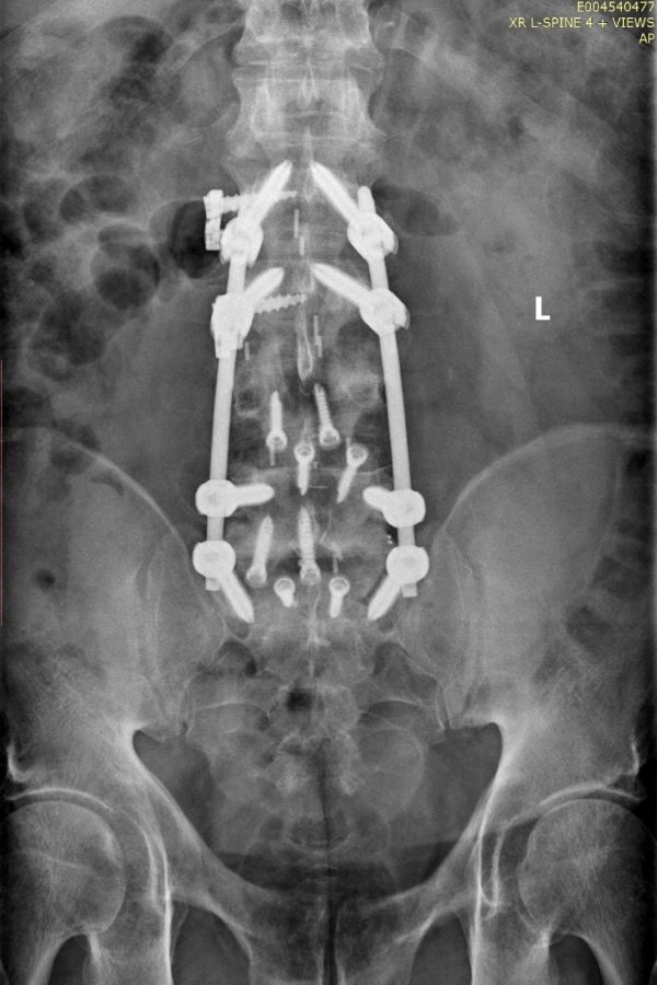 Chris Ownbey spine surgery X-ray from his recovery journey