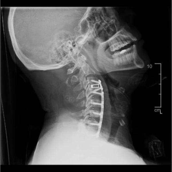 Xray